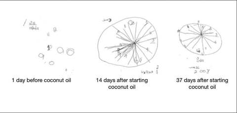 Improving Alzheimer’s - The Coconut Oil Breakthrough That Changed Everything